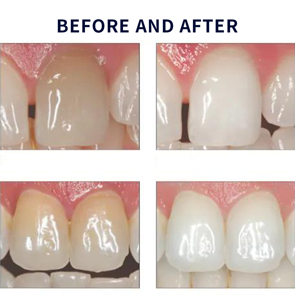 Opalescence Whitening 20% PF 2 - Teeth Whitening With Hydrogen Peroxide ulasan dan harga