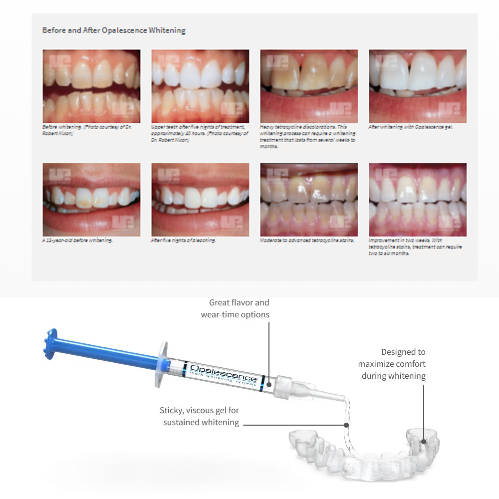 Opalescence Whitening 20% PF 2 - Teeth Whitening With Hydrogen Peroxide ulasan dan harga