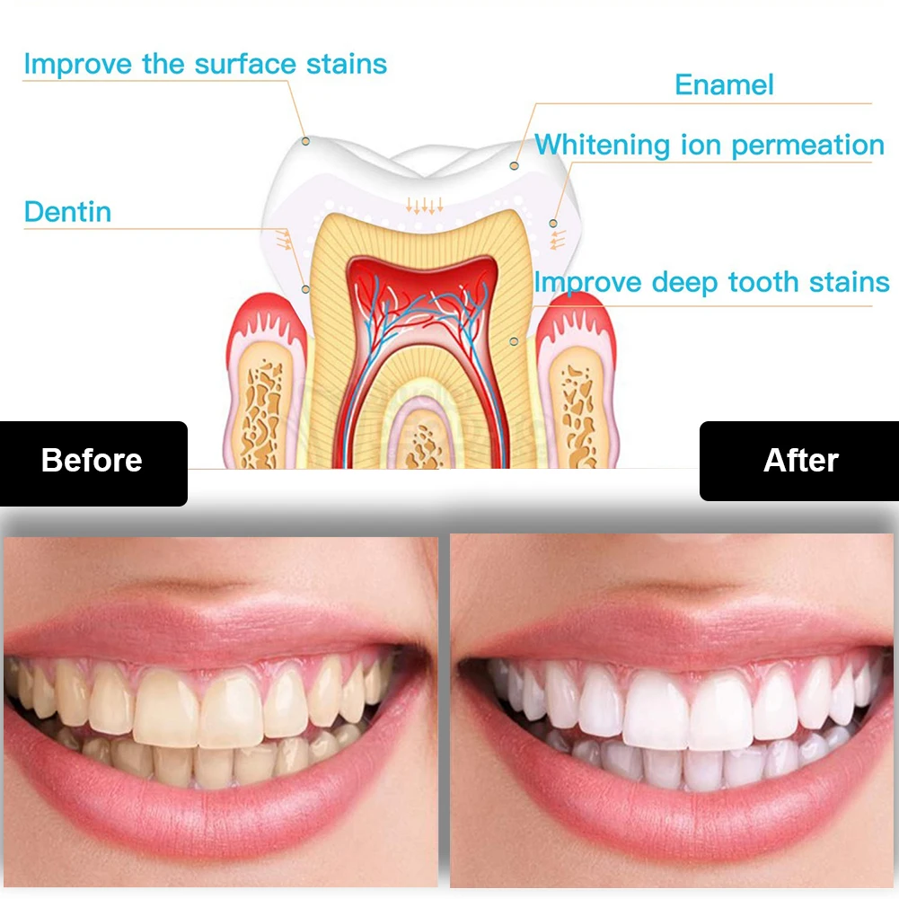 Dental Teeth Whitening Kit Min - Teeth Whitening With Hydrogen Peroxide ulasan dan harga